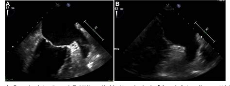 Figure 1 from High-risk left atrial appendage occlusion via ...