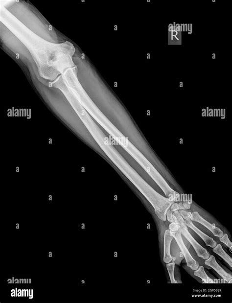 With a broken arm Black and White Stock Photos & Images - Alamy