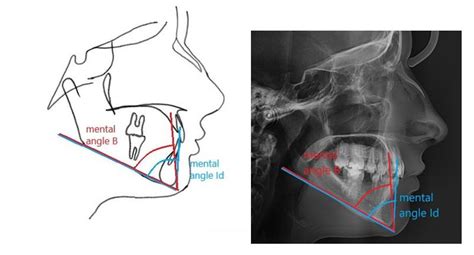 Angular measurements of the mandible used in the study. (a)shows ...