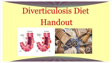 Printable Diverticulosis Diet Handout