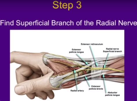 De Quervain S Tenosynovitis Surgery - slidesharetrick