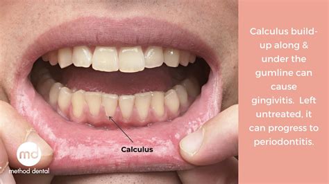 The Difference Between Plaque And Calculus - Method Dental