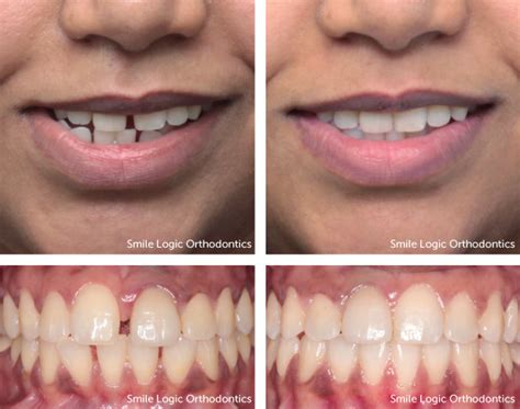 Orthodontics – Evolution Dental Chamber