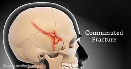 Simple Skull Fracture