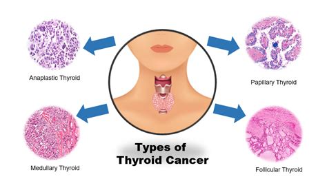 Thyroid Cancer: Symptoms, Types, Causes And Treatment Overview