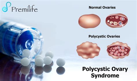 Polycystic Ovary Syndrome | Premilife - Homeopathic Remedies