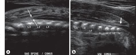 Spina Bifida Ultrasound