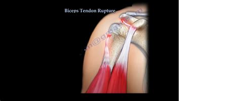 Proximal Biceps Tendon Rupture — OrthopaedicPrinciples.com