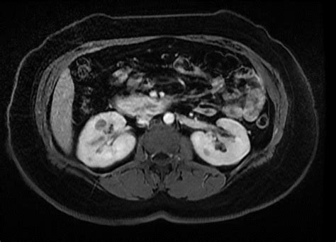 MR ABDOMEN WITH AND WITHOUT CONTRAST - Greater Waterbury Imaging Center