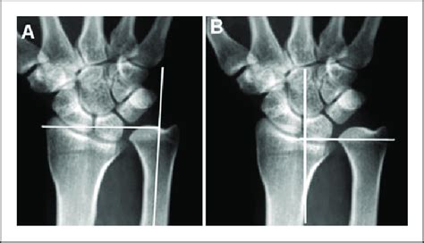 (A) In cases of positive ulnar variance without Madelung's deformity... | Download Scientific ...