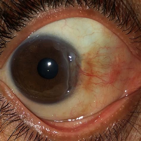 Peripheral corneal ulceration - American Academy of Ophthalmology