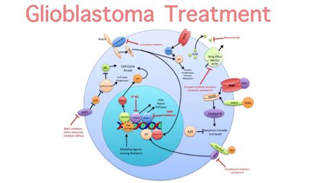 Glioblastoma Treatment - IMC Grupo