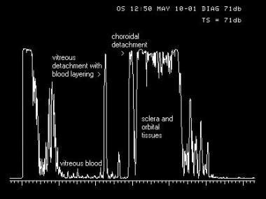 Ultrasound Has Never Been Shown in a Published Case Report to Cause a Cataract: My Current ...