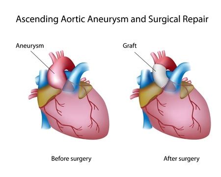 Thoracic Aortic Aneurysm - Treatment in Israel | D.R.A Medical