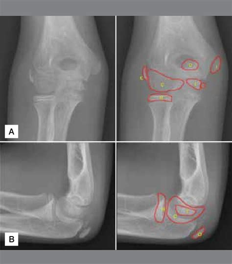 Radiographic Elbow Anatomy