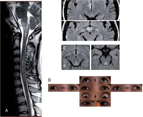 Internuclear Ophthalmoplegia Mri