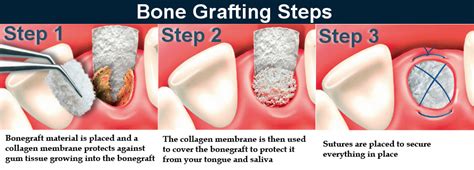 Bone Grafting Burbank | My Dentist Burbank