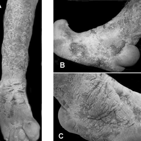 (PDF) Elephantiasis Nostras Verrucosa of Lower Limb: a Case Report