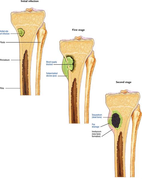 Tips Kesehatan & Orthopaedi: Osteomyelitis