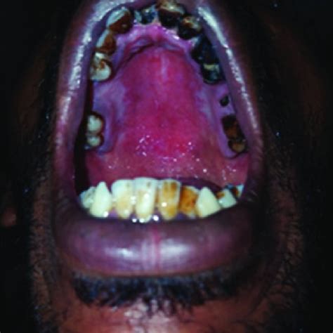 (PDF) Oral erythematous candidiasis: A case report