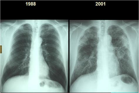 Why Black Lung Disease Is Deadlier Than Ever Before | Science | Smithsonian