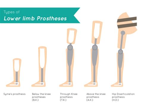 lower-limb-prosthesis-leg-amputation-rehabilitation-propel-physiotherapy - Propel Physiotherapy