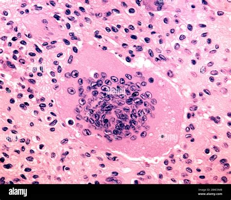 Giant Cell Tumor Histology