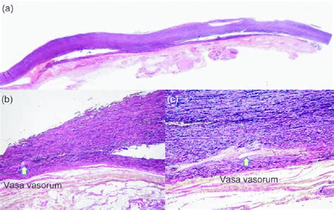 The dissection occurred alongside the course of the vasa vasorum (thick ...