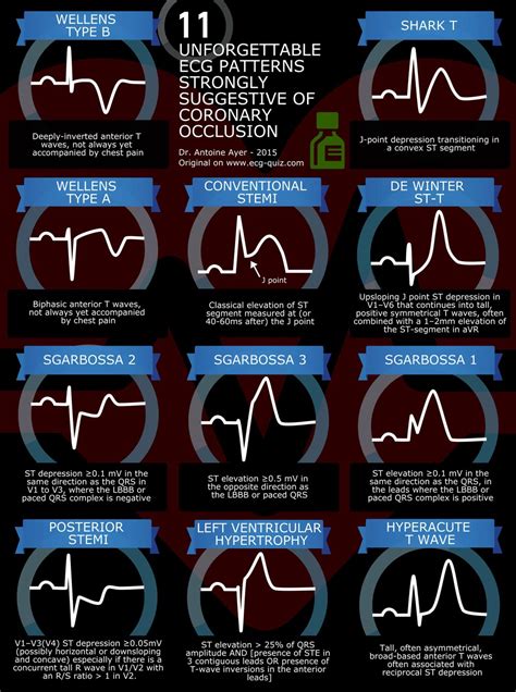 A Handy Guide to STEMI interpretation (x-post /r/medicine) : r/nursing