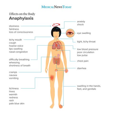 Anaphylaxis: Signs, causes, and treatment