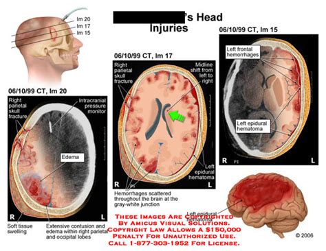 AMICUS Illustration of amicus,injury,head,brain,hematoma,bleeding,bleed,epidural,blood,swelling ...