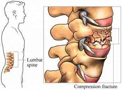 Best Cost Intrathecal Pain Pump Insertion Surgery, Treatment Hospital in India