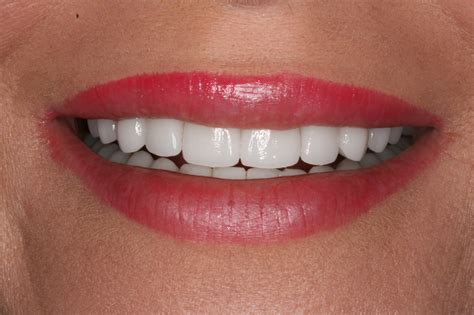 The Art of Porcelain Veneer Design: Different Veneers for Different Patients - Konig Center for ...