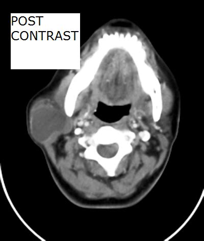 First Branchial Cleft Cyst-CT - Sumer's Radiology Blog