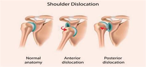 Latarjet Shoulder Operation - What does this mean? | BRH Physiotherapy