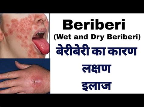 Beriberi (Wet and dry) disease symptoms in hindi | Vitamin B1 (thiamine ...