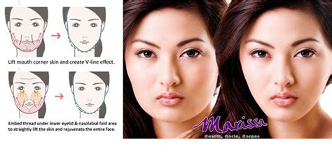 FILLER: Thread Lift & V Shape