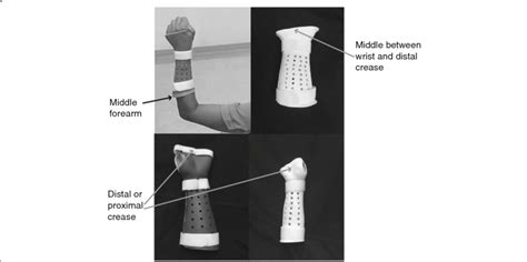 A short arm cast extends from the mid-forearm to the distal or proximal ...