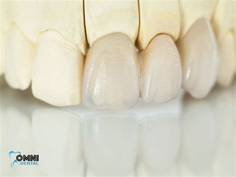 Porcelain Crown Procedure - Omni Dental