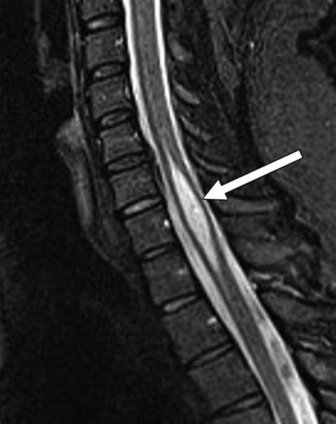 MRI of a Syrinx: Is Contrast Material Always Necessary? | AJR