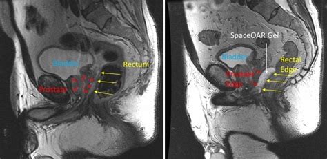 Reducing Side Effects During Radiotherapy for Prostate Cancer ...