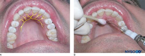 regional-anesthesia-nasopalatine-nerve-location-needle-insertion-just-lateral-to-the-incisive ...