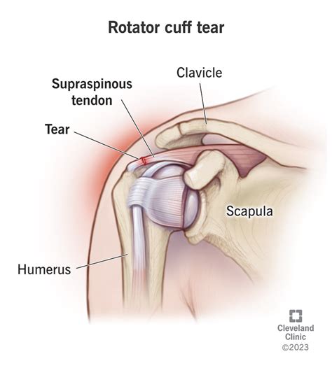 Rotator Cuff Tear Symptoms Treatment 3888 | The Best Porn Website