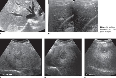 Figure 7 from LIVER HEMANGIOMAS : ULTRASOUND AND CLINICAL FEATURES * | Semantic Scholar