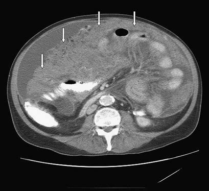 CT scan abdomen demonstrating omental caking (arrows). | Download Scientific Diagram