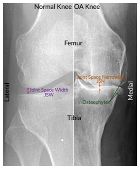 Inflammatory and degenerative disorders of bone | Musculoskeletal system | Pathology ...