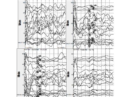 Variable Intraoperative Somatosensory Evoked Potentials?