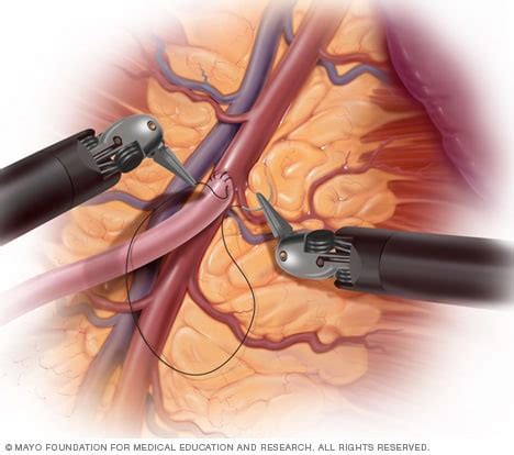 Robotic surgery - Mayo Clinic