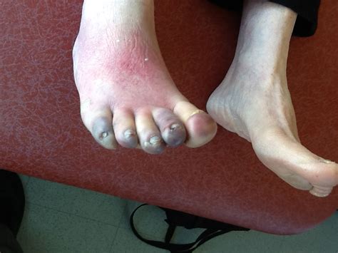 Foot and Ankle Problems By Dr. Richard Blake: PAD: What the the risk factors? And What is it?