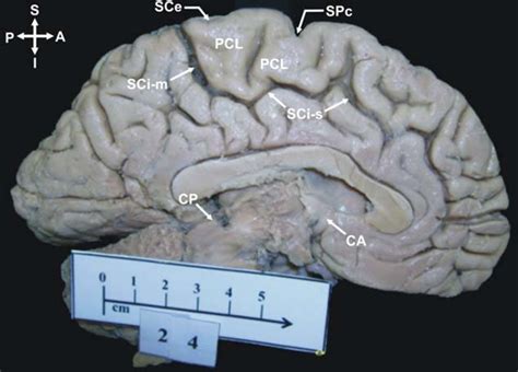 Paracentral lobule (PCL)-continuous type (precentral and postcentral ...